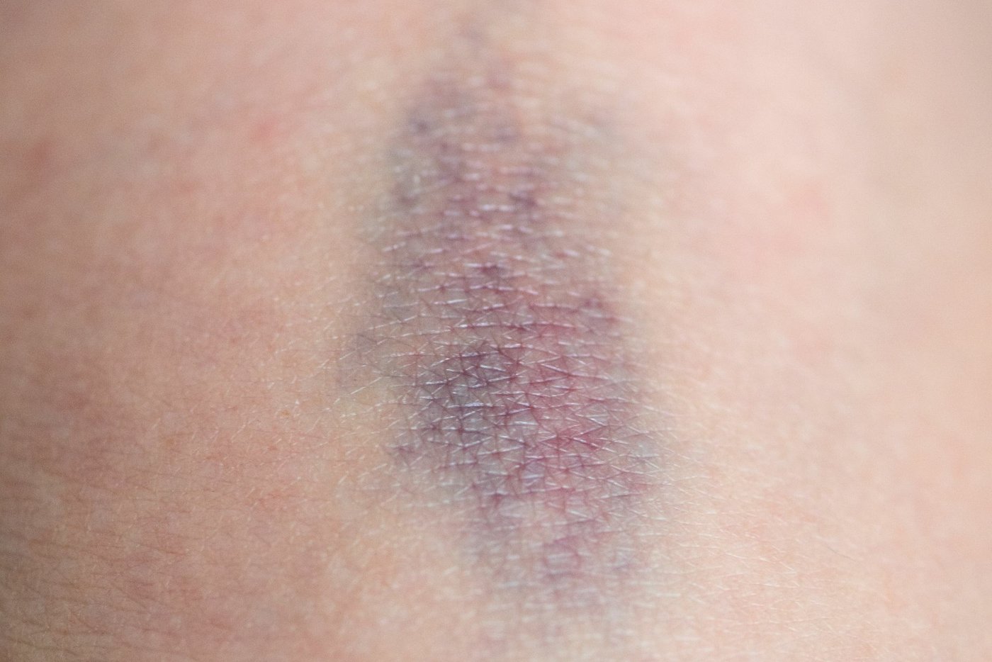 bluterguss an der brust bilder