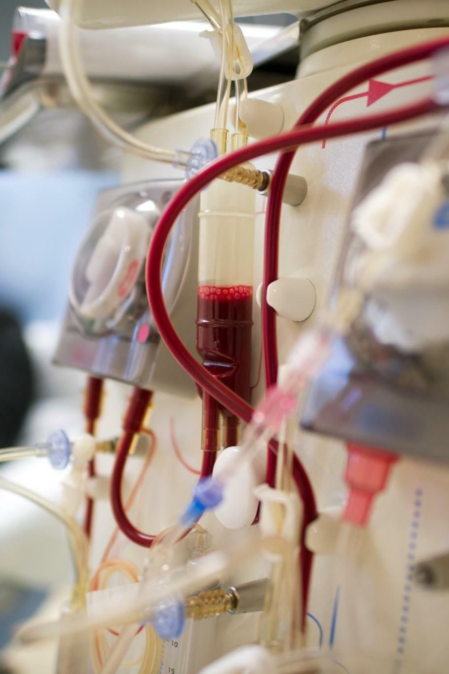 Medizinischer Lebensretter: Die knstliche Niere wird 75
