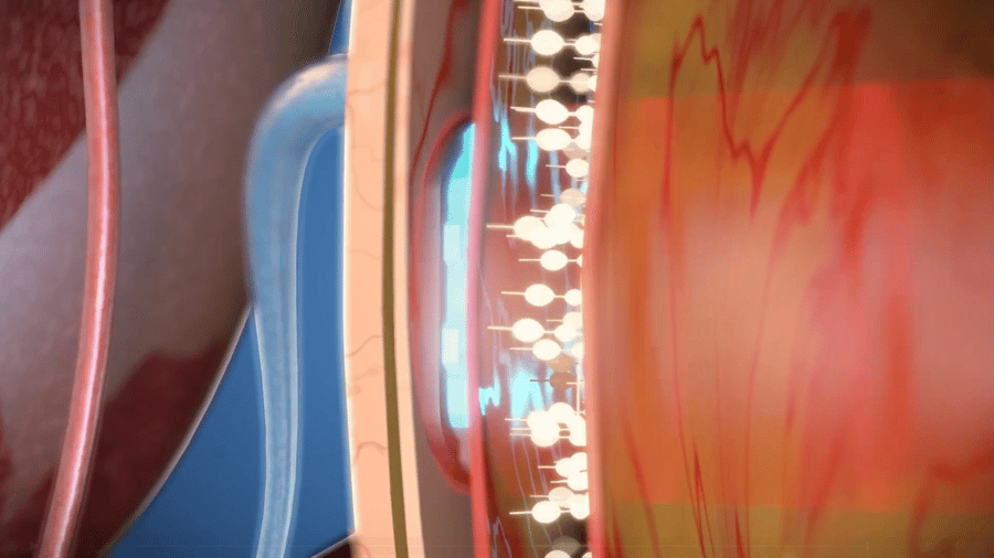 Gehirnchips: Ein Code fürs Gehirn? Der Wettlauf um das beste Implantat – und Europa mischt mit
